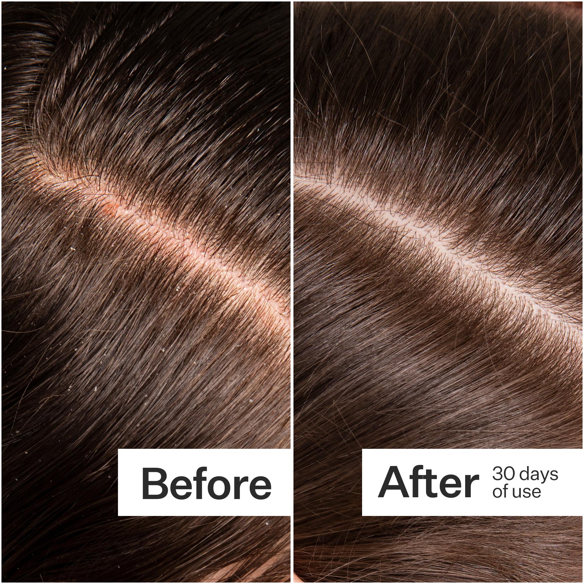Before/After of scalp when using Act+Acre Microbiome Cooling Scalp Serum