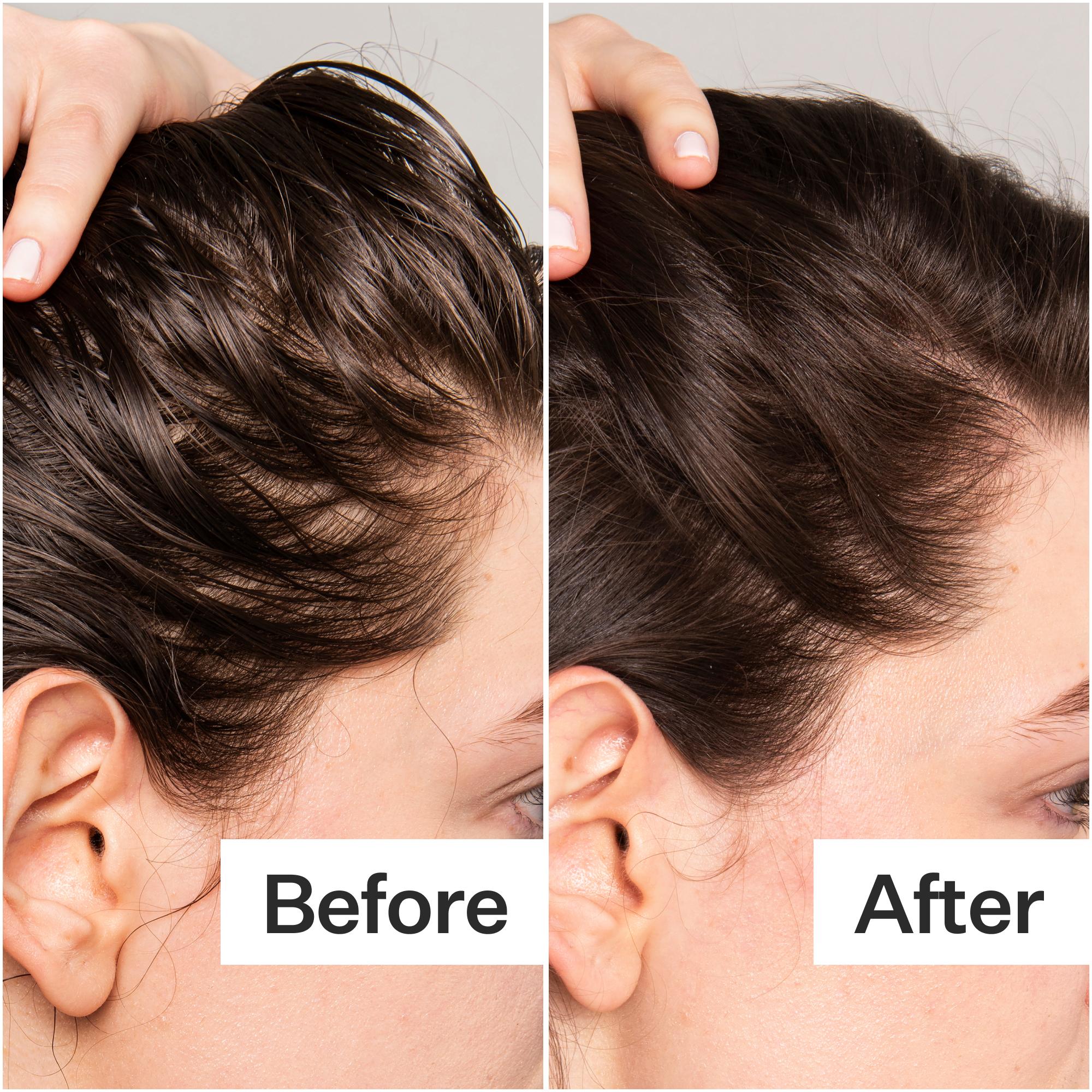 Before/After of scalp when using Act+ Acre BHA Salicylic Acid Scalp Exfoliator