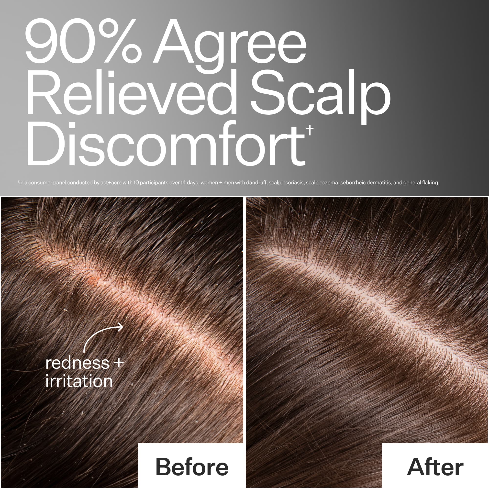 Before/After of scalp when using Act+Acre Microbiome Cooling Scalp Serum