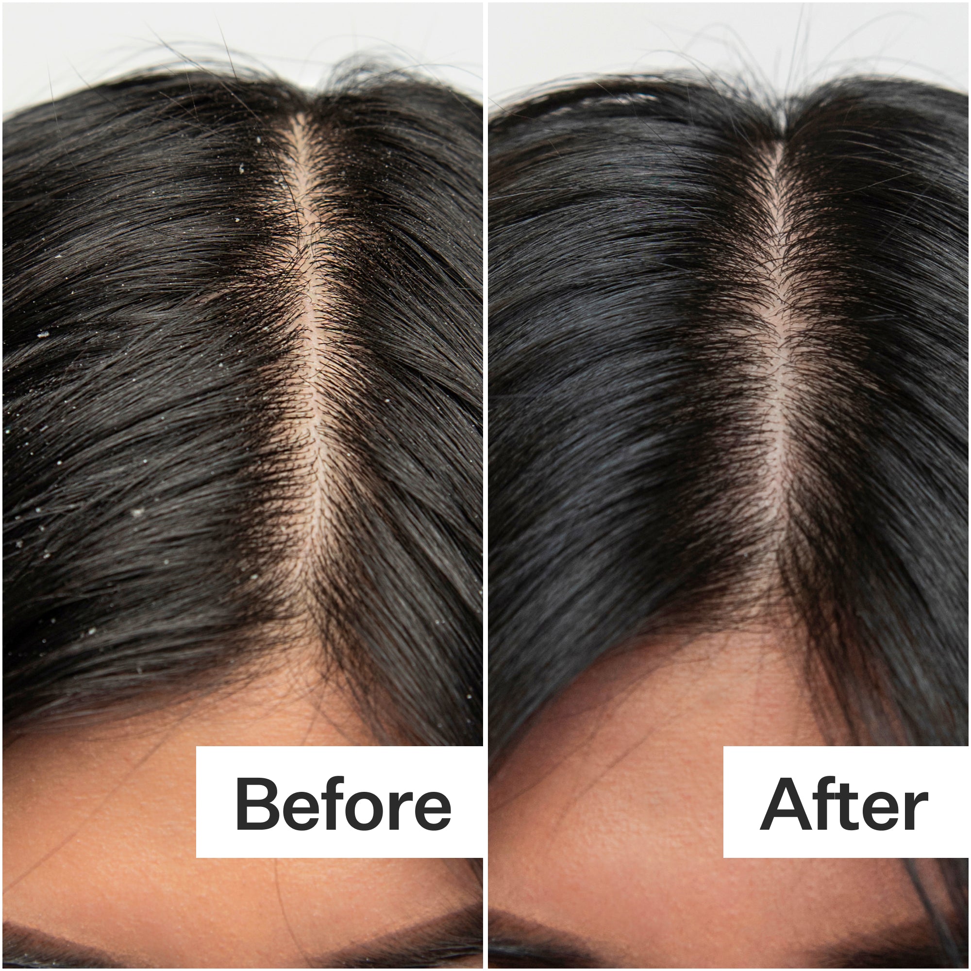 Before/After of scalp when using Act+ Acre BHA Salicylic Acid Scalp Exfoliator