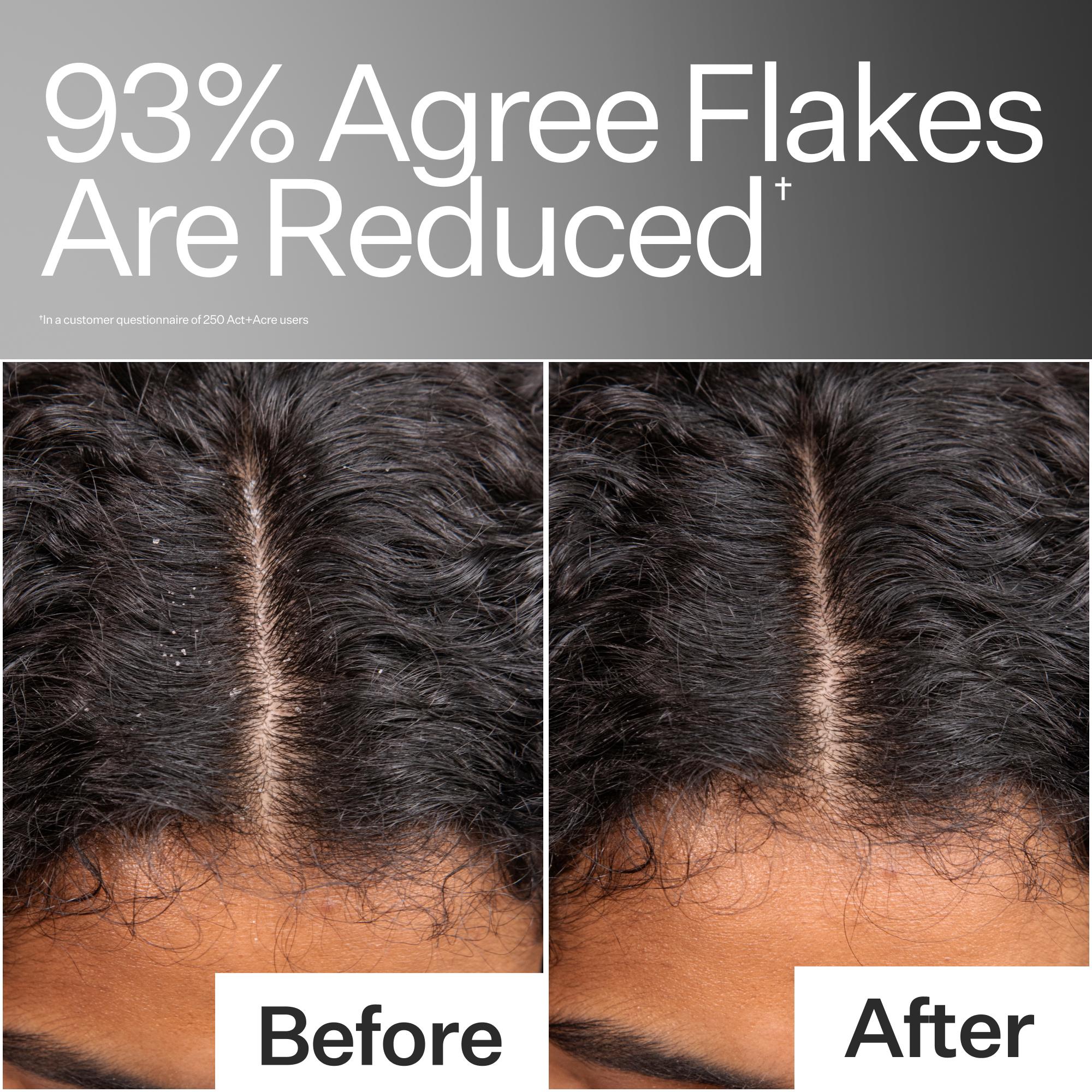 Before/After of improved scalp health Act+Acre Scalp Relief System