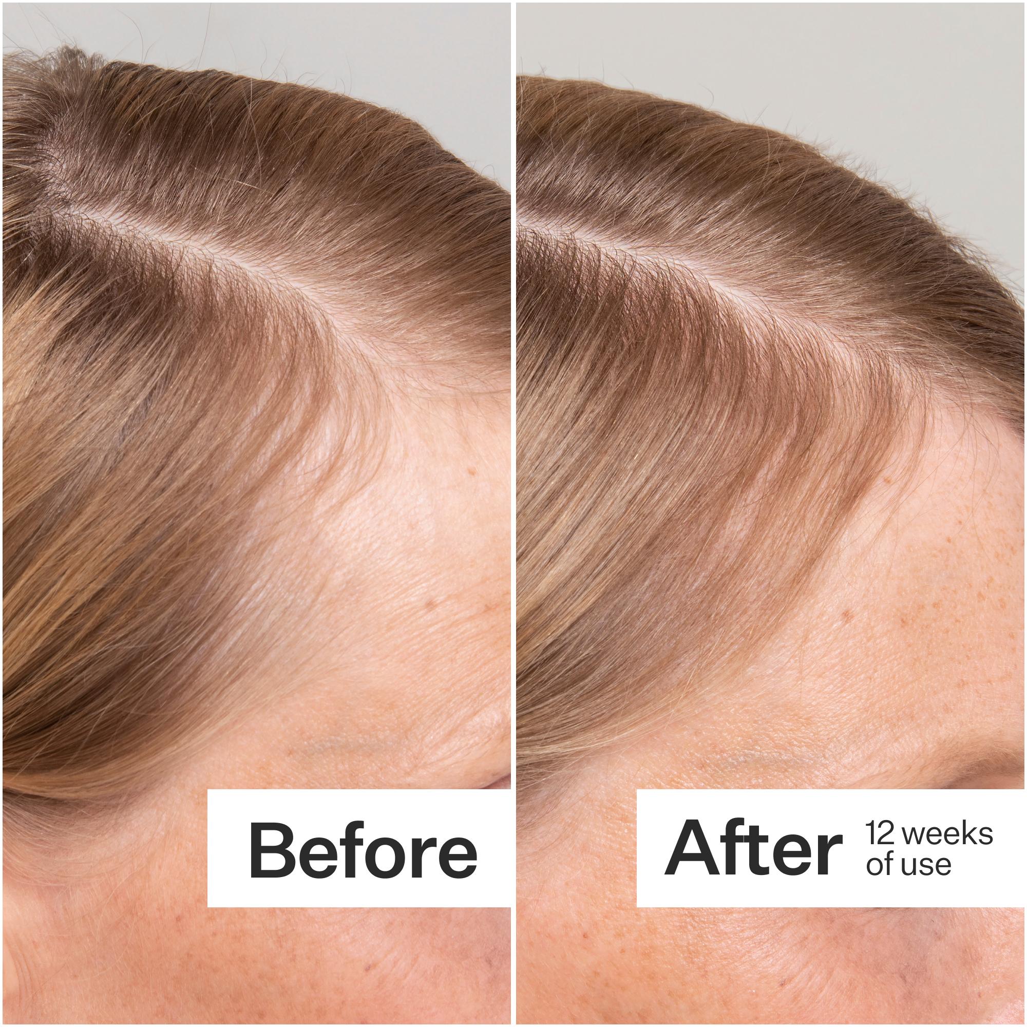 Side-by-side comparison of hair before and after 12 weeks of use, showing noticeable improvement in thickness and coverage.