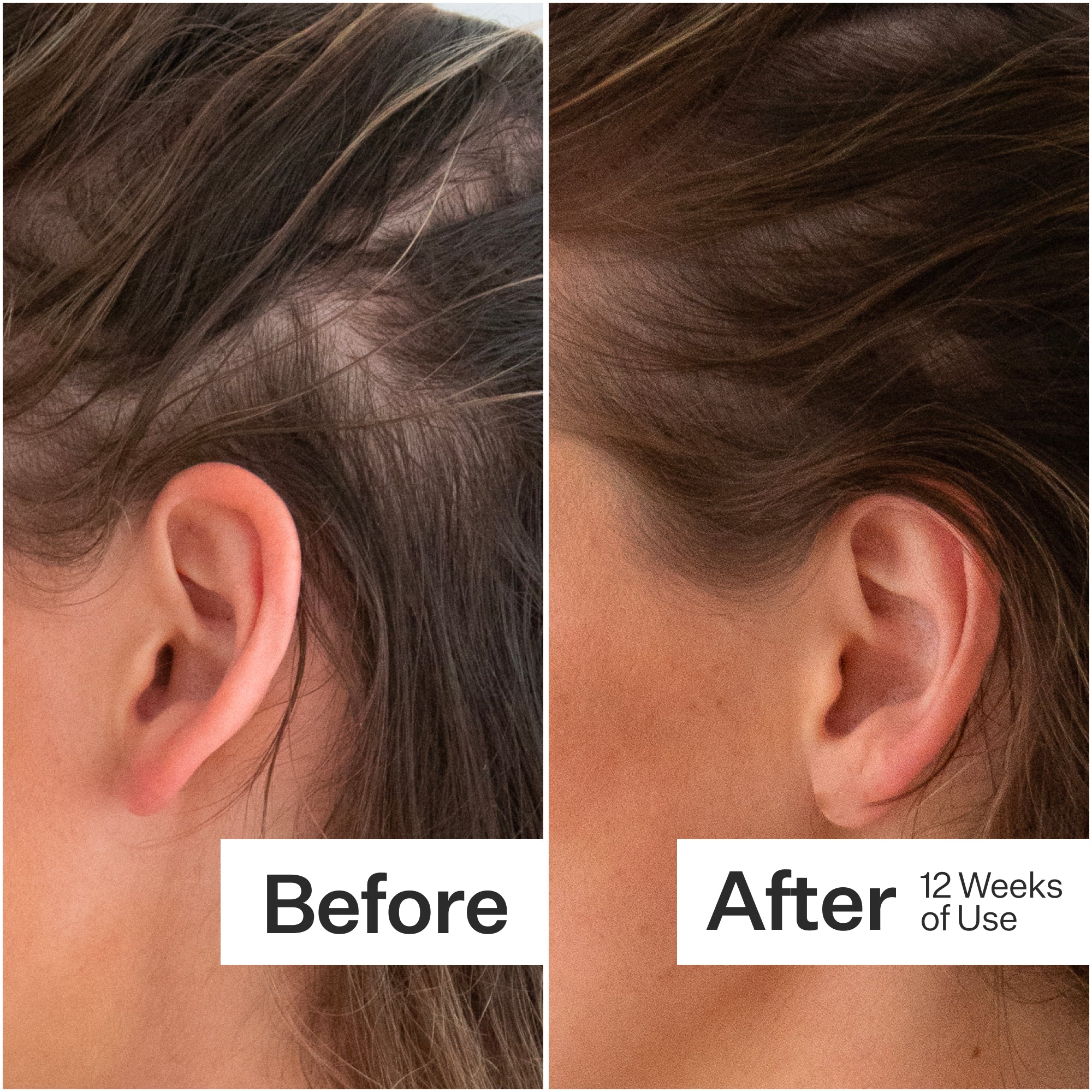 Side-by-side comparison of hair growth: left shows thinning hair, right shows improved fullness after 12 weeks of use.