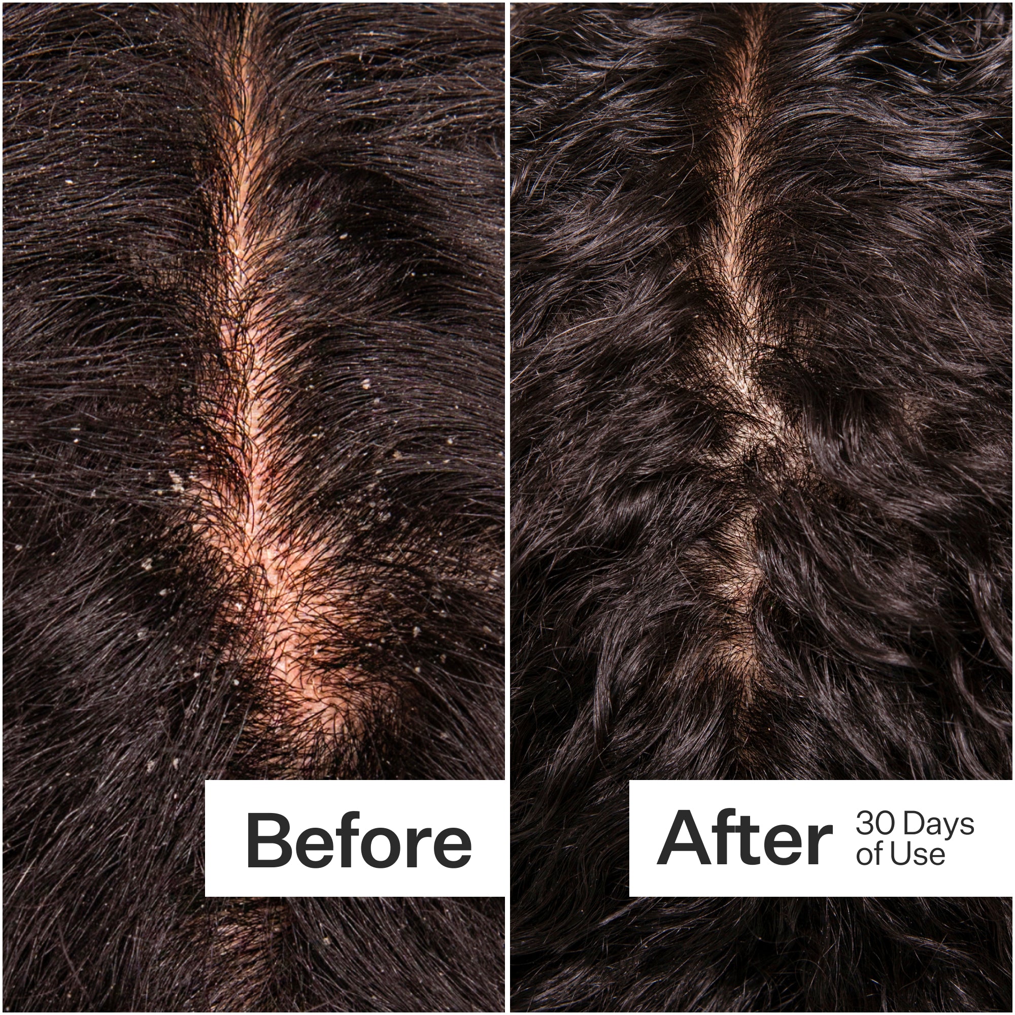 Side-by-side comparison of a scalp before and after 30 days of use, showing improved hair health and reduced flakes.
